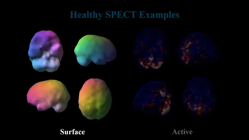 The ADHD Doctor: &ldquo;I&rsquo;ve Scanned 250,000 Brains&rdquo; You (Steven Bartlett) Have ADHD!!! Dr Daniel Amen 007