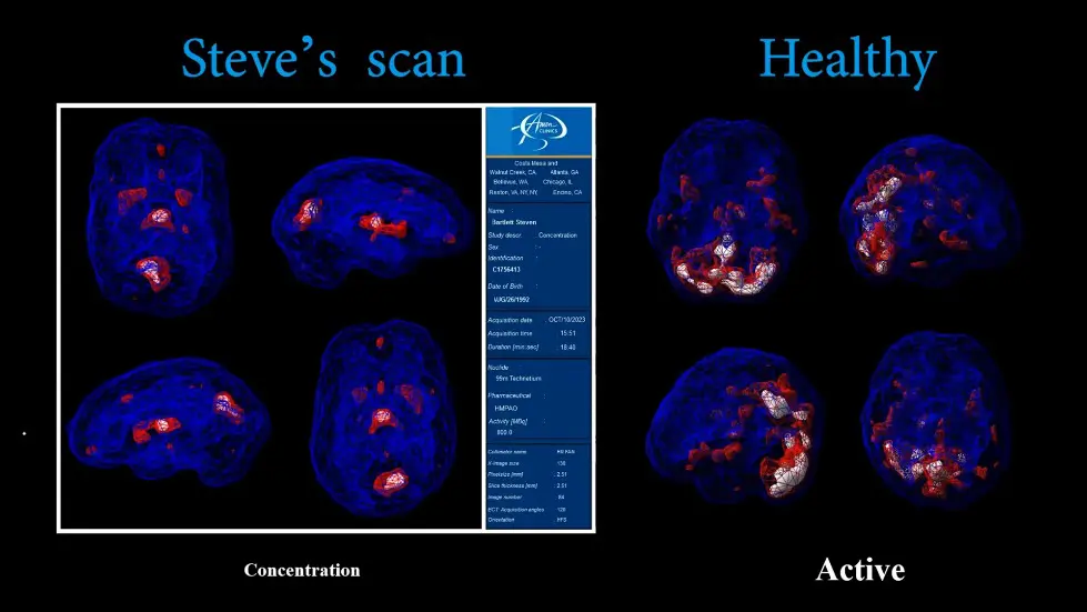 The ADHD Doctor: &ldquo;I&rsquo;ve Scanned 250,000 Brains&rdquo; You (Steven Bartlett) Have ADHD!!! Dr Daniel Amen 013